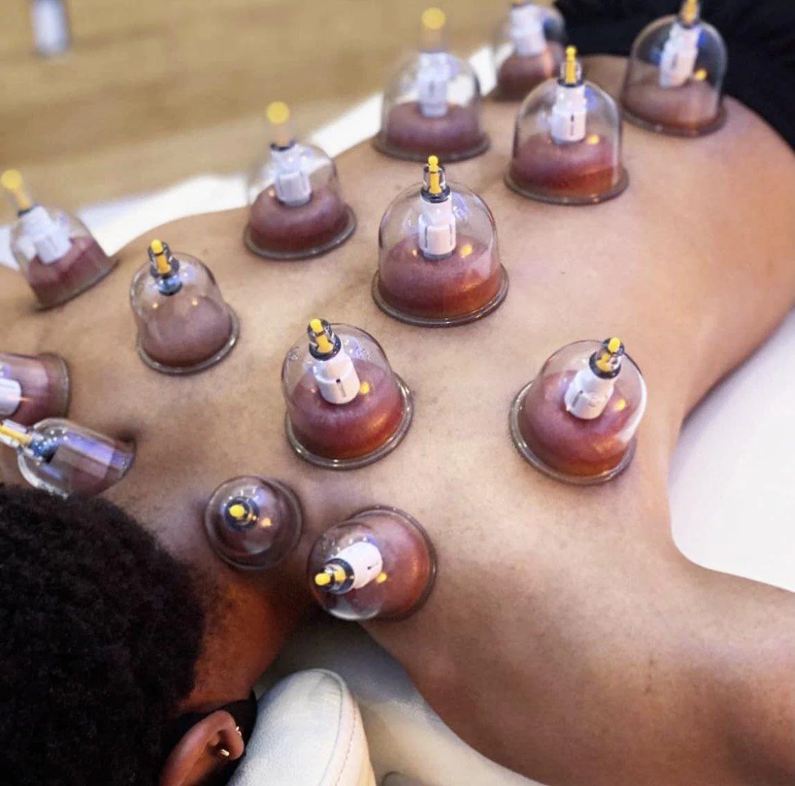 Cupping
